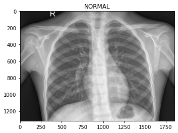 Identifying pneumonia from chest x-rays using EfficientNet